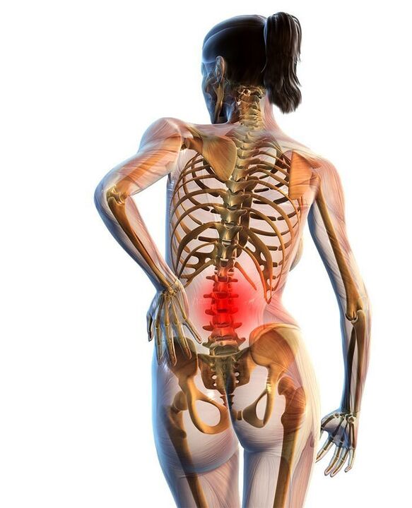 Osteochondrose der Lendenwirbelsäule tritt am häufigsten auf.
