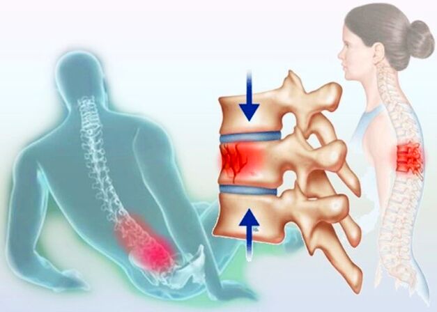 Sogar eine normale Verletzung kann die Entwicklung einer Osteochondrose hervorrufen.