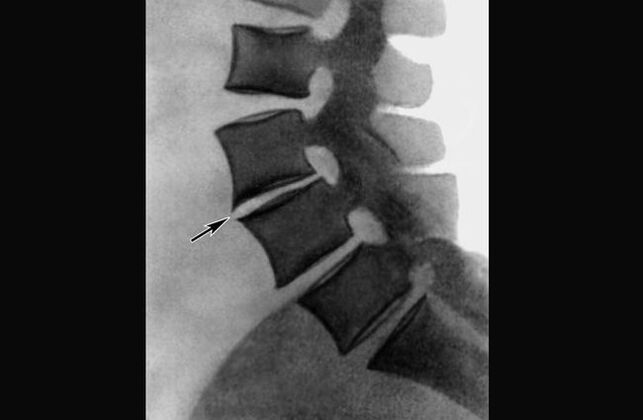Manifestationen einer Osteochondrose der Brustwirbelsäule im Röntgenbild.